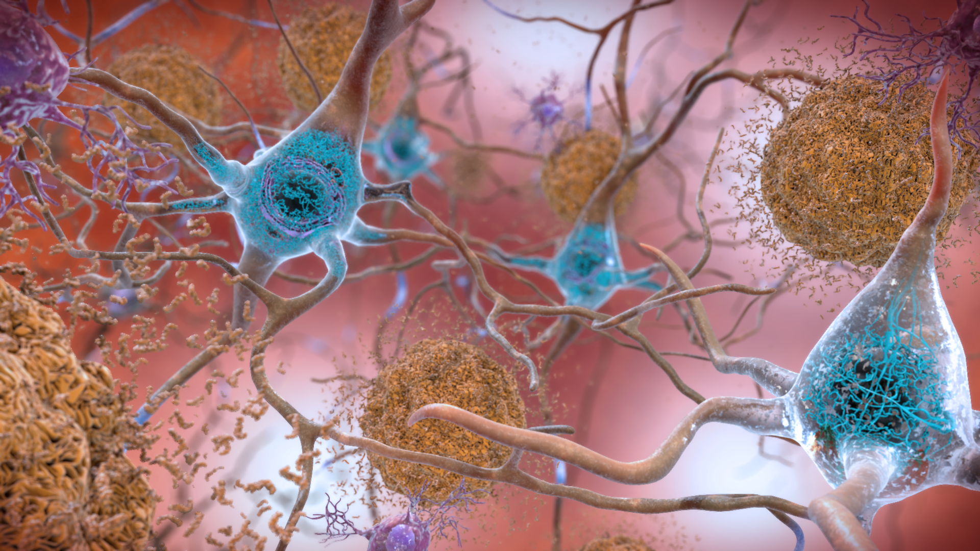 Artist's rendering of amyloid-beta plaque (beige clumps) outside of neurons and neurofibrillary tangles (blue) inside of neurons. Credit: National Institute on Aging, National Institutes of Health 