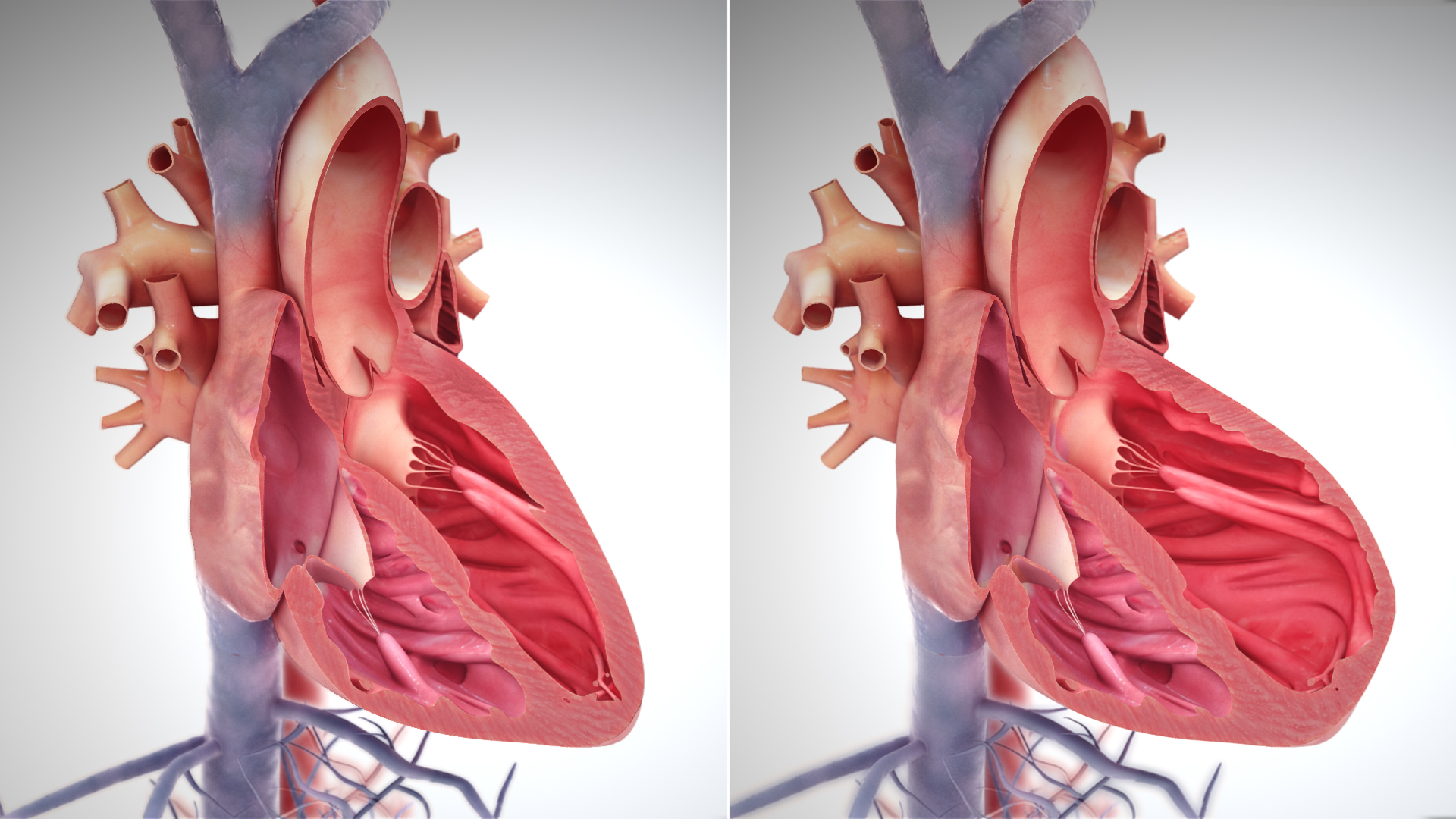 On the left, a diagram of a healthy heart, on the right, a diagram of a heart in heart failure. The walls of the heart are thin, making its circulation of blood too weak. Credit: Creative Commons by Scientificanimations.com (Attribution-Share Alike 4.0 International)