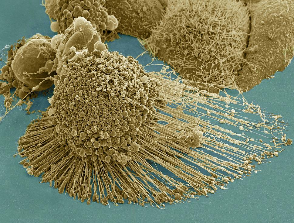 A dying cancer cell with filopodia stretched out to its right. The protrusions help cancer migrate. Stock NIH NCMIR image. The image does not display a cell treated in the Georgia Tech study. Credit: NIH-funded image of HeLa cell / National Center for Microscopy and Imaging Research / Thomas Deerinck / Mark Ellisman. Use may require permission.