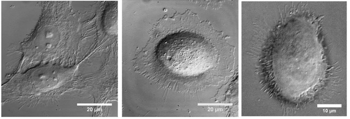 From left to right: Untreated lab culture cancer cell, lab culture cancer cell with gold nanorods attached, lab culture cancer cell after addition of gentle NIR laser light. Credit: Georgia Tech / El-Sayed group