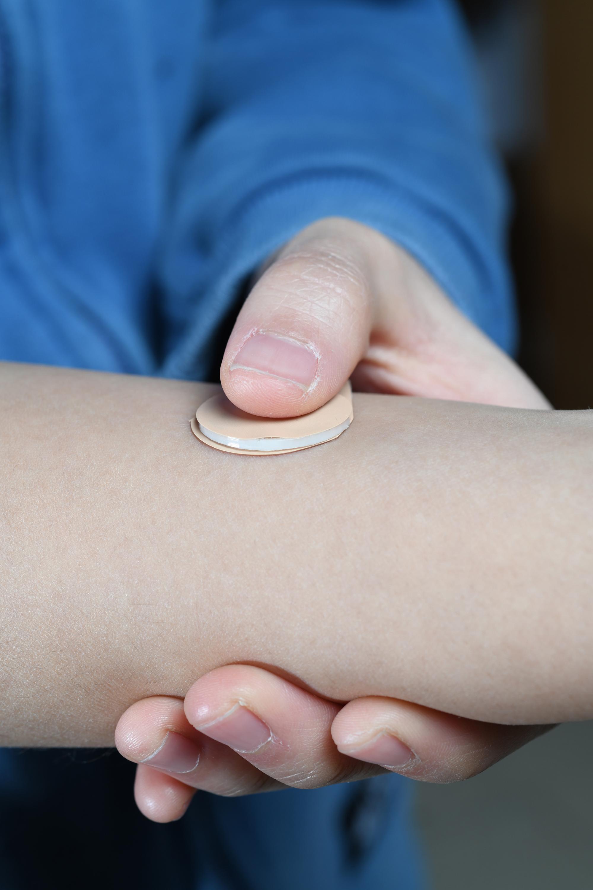 Image shows how an experimental microneedle contraceptive skin patch could be applied to the skin. Designed to be self-administered by women for long-acting contraception, the patch could provide a new family planning option. (Credit: Christopher Moore, Georgia Tech)