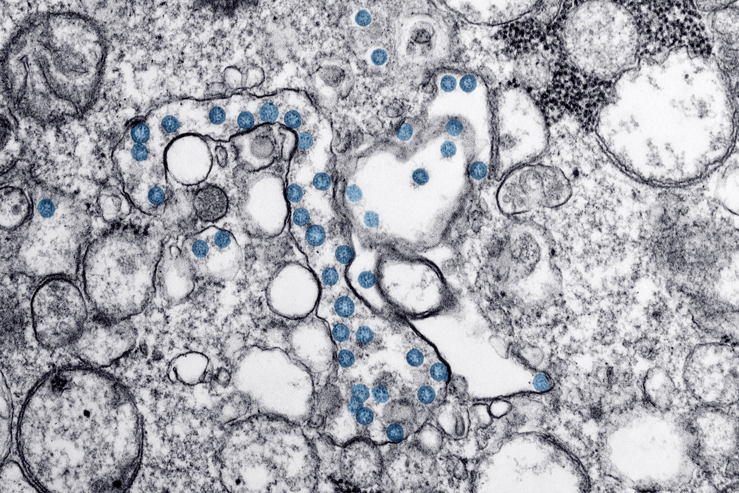 Transmission electron microscope image from the first U.S. case of COVID-19. The spherical viral particles, colorized blue, contain cross-sections through the viral genome, seen as black dots. (Credit: Centers for Disease Control and Prevention: Hannah A. Bullock and Azaibi Tamin)