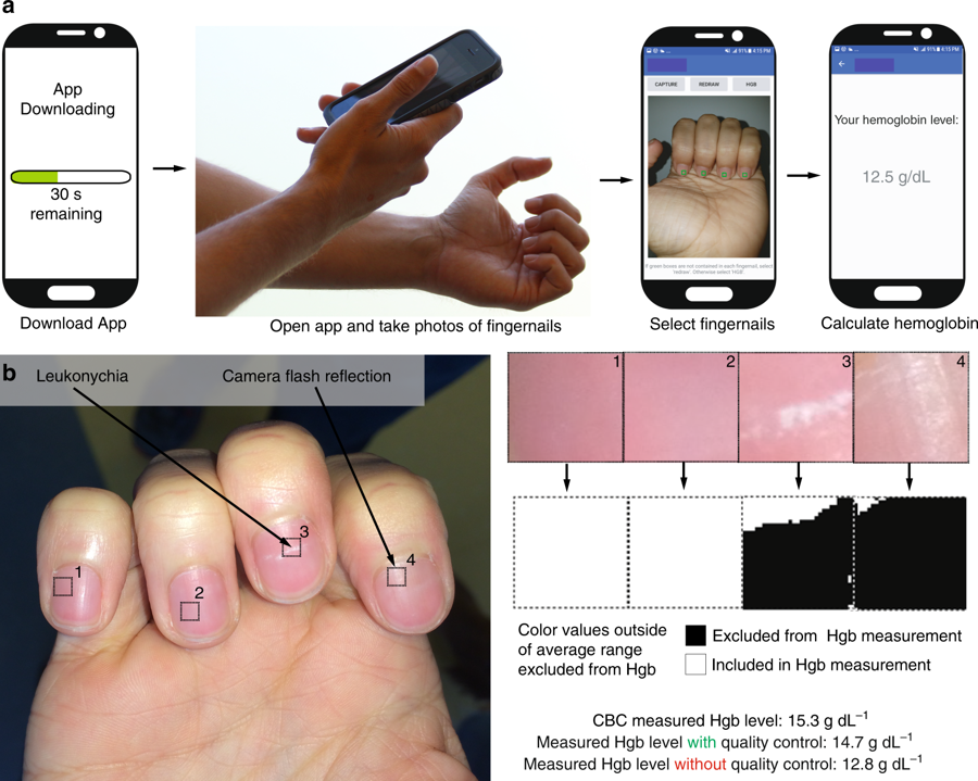 An illustration of how the anemia test smartphone app works. Credit: Lam / Emory / Georgia Tech
