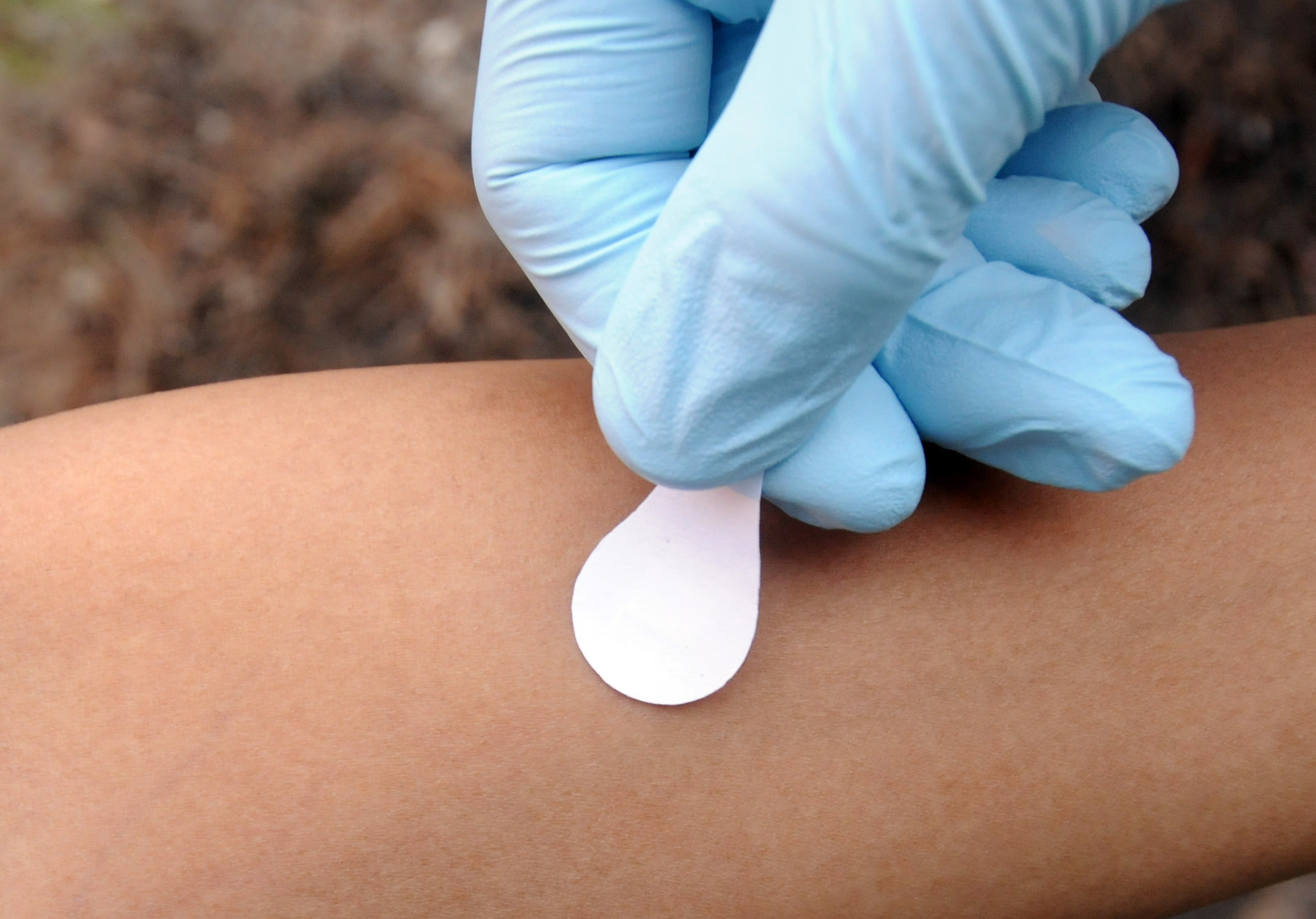 Administering measles vaccine with a microneedle patch could be easier than getting the vaccine through a hypodermic needle. (Photo: Gary Meek)