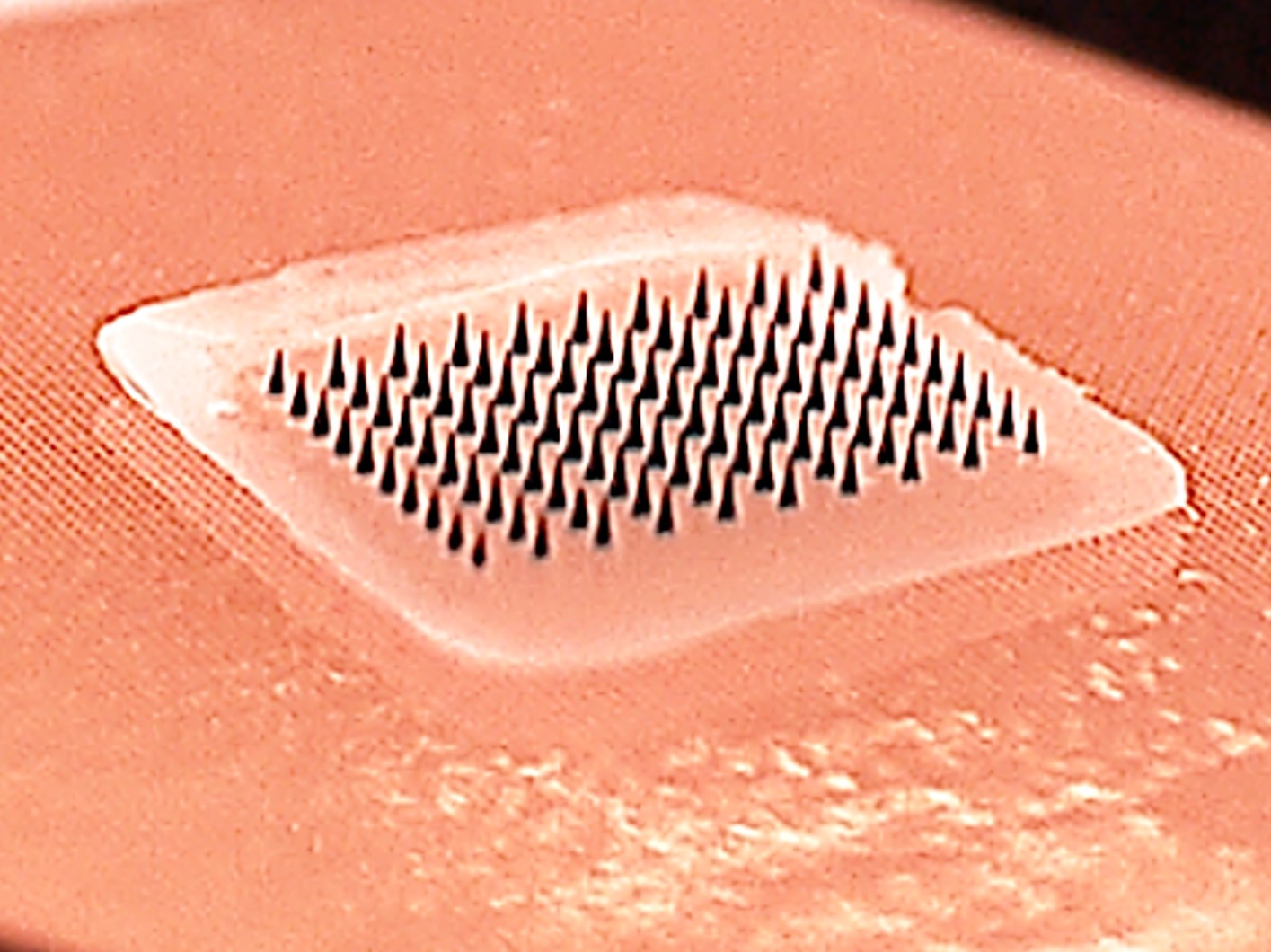 This close-up image shows a microneedle array containing influenza vaccine. When pressed into the skin, the tiny needles dissolve, carrying vaccine into the skin. A majority of study participants said they would prefer to receive the influenza vaccine using patches rather than traditional hypodermic needles.