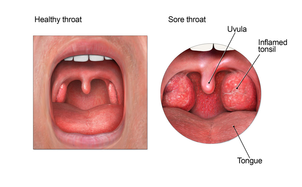 Illustration of a sore throat, right. Credit: Centers for Disease Control and Prevention