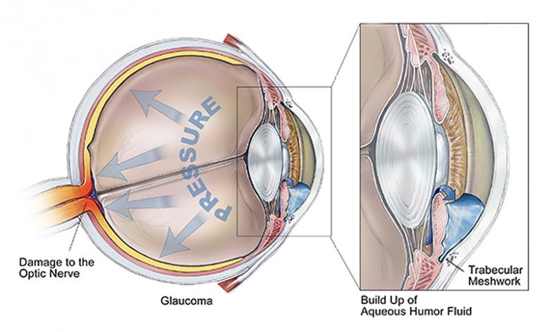 The road to blindness via glaucoma: A depiction of how blockage of fluid flow in the trabecular meshwork, located near the cornea, can lead to pressure build-up in the aqueous humor of the eye, resulting in optic nerve and retinal damage. Credit: BrightFocus Foundation