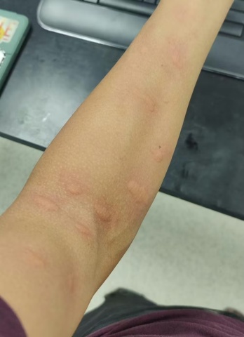 Image of Chris Zuo's arm after an experiment