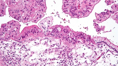 Micrograph of a mucinous ovarian tumor (Photo National Institutes of Health)