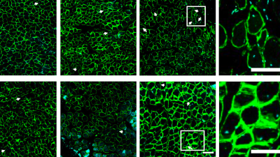 Rotator Cuff injury repair