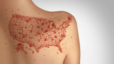 Measles infections send 1 in 5 people to the hospital.