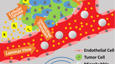 An illustration of improved delivery of anti-cancer drugs to malignancies in the brain. On the left half, focused ultrasound agitates microbubbles, which breach the blood-brain barrier, allowing drug molecules to get through. The forces also stir interstitial fluid to circulate the drug, and they also encourage the drug to cross cell membranes more easily into tumor cells. Credit: Massachusetts General Hospital / Georgia Tech / Arvanitis / Askoxylakis