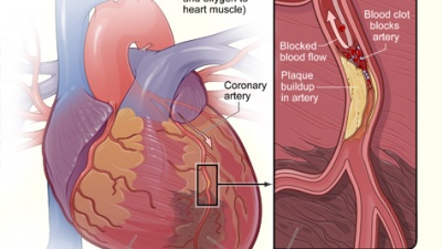 Atherosclerosis is the foremost cause of coronary artery disease, the number one killer of people in the United States. Credit: National Institutes of Health