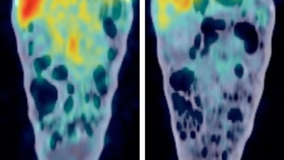 PET/CT images before, while viremic, and during treatment. Virus detection in the gastrointestinal tract decreases under treatment but is not completely eradicated. (Courtesy of Phil Santangelo)