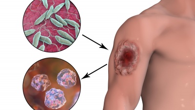 There are some 30 species of Leishmania parasites, which take on two different forms in their life cycle. Illustrated here are promastigotes (top) and amastigotes (bottom) with a typical boil caused by a leishmaniasis infection. Rights: iStock / Getty / purchased / not transferable 