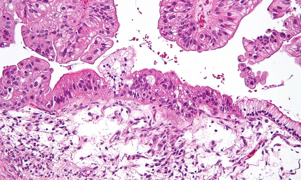 Micrograph of a mucinous ovarian tumor (Photo National Institutes of Health)